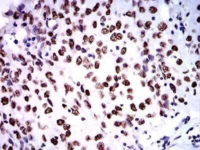 Immunohistochemistry: ZFP91 Antibody (8C3D5) [NBP2-61847] - Analysis of paraffin-embedded ovarian cancer tissues using ZFP91 mouse mAb with DAB staining.