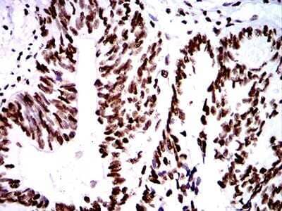 Immunohistochemistry: ZFP91 Antibody (8C3D5) [NBP2-61847] - Analysis of paraffin-embedded rectum cancer tissues using ZFP91 mouse mAb with DAB staining.