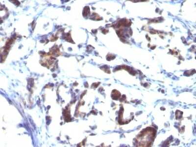 Immunohistochemistry-Paraffin: ZFYVE28 Antibody (LST2/2426) [NBP3-08899] - Formalin-fixed, paraffin-embedded human Gastric Carcinoma stained with ZFYVE28 Mouse Monoclonal Antibody (LST2/2426)