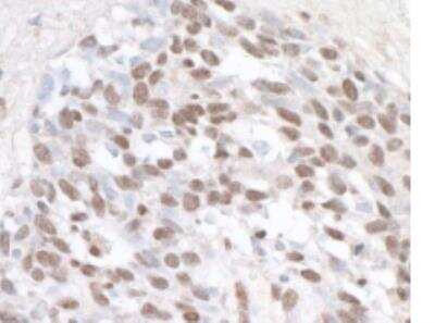 Immunohistochemistry-Paraffin: ZHX1 Antibody [NB600-244] - Section of human lung carcinoma. Antibody: Affinity purified rabbit anti- ZHX1 used at a dilution of 1:1,000 (1ug/ml). Detection: DAB