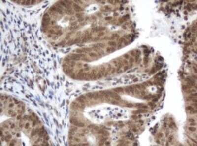 Immunohistochemistry: ZIM2 Antibody (6D12) [NBP2-46415] - Analysis of Adenocarcinoma of Human endometrium tissue. (Heat-induced epitope retrieval by 10mM citric buffer, pH6.0, 120C for 3min)