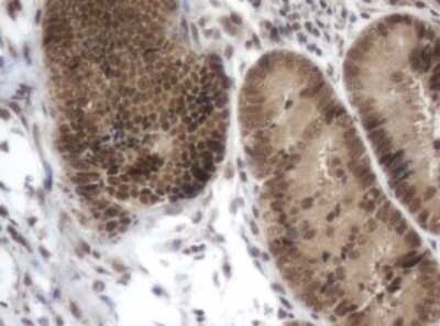 Immunohistochemistry: ZIM2 Antibody (OTI6D12) - Azide and BSA Free [NBP2-74928] - Analysis of Adenocarcinoma of Human colon tissue. (Heat-induced epitope retrieval by 10mM citric buffer, pH6.0, 120C for 3min)
