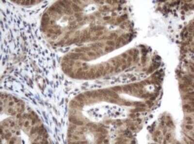 Immunohistochemistry: ZIM2 Antibody (OTI6D12) - Azide and BSA Free [NBP2-74928] - Analysis of Adenocarcinoma of Human endometrium tissue. (Heat-induced epitope retrieval by 10mM citric buffer, pH6.0, 120C for 3min)