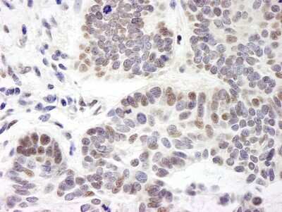 <b>Biological Strategies Validation. </b>Immunohistochemistry-Paraffin: ZMYM3 Antibody [NB100-458] - Sample: FFPE section of human skin basal cell carcinoma. Antibody: Affinity purified rabbit anti- ZNF261 used at a dilution of 1:5,000 (0.2ug/ml). Detection: DAB