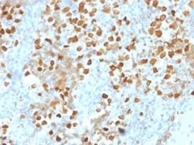 Immunohistochemistry-Paraffin: ZMYM3 Antibody (PCRP-ZMYM3-2F10) [NBP3-07551] - Formalin-fixed, paraffin-embedded human breast carcinoma stained with ZMYM3 Mouse Monoclonal Antibody (PCRP-ZMYM3-2F10).