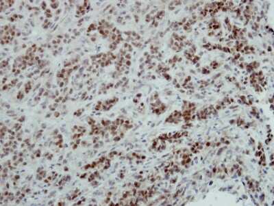 Immunohistochemistry-Paraffin: ZNF133 Antibody [NBP2-20963] - Immunohistochemical analysis of paraffin-embedded TOV-21G xenograft, using antibody at 1:100 dilution.