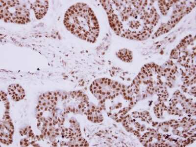 Immunohistochemistry-Paraffin: ZNF148 Antibody [NBP2-20964] - Human breast cancer, using ZNF148 antibody [N1N2], N-term  antibody at 1:250 dilution. Antigen Retrieval: Trilogy™ (EDTA based, pH 8.0) buffer, 15min.