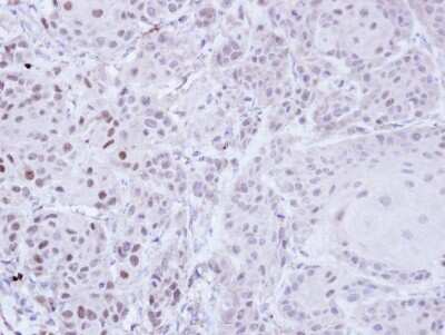 Immunohistochemistry-Paraffin: ZNF165 Antibody [NBP1-32507] - Paraffin-embedded Cal27 Xenograft, using antibody at 1:100 dilution.
