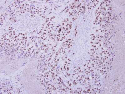 Immunohistochemistry-Paraffin: ZNF217 Antibody [NBP2-20978] - H661 xenograft, using ZNF217 antibody [N3C2], Internal antibody at 1:250 dilution. Antigen Retrieval: Citrate buffer, pH 6.0, 15 min.
