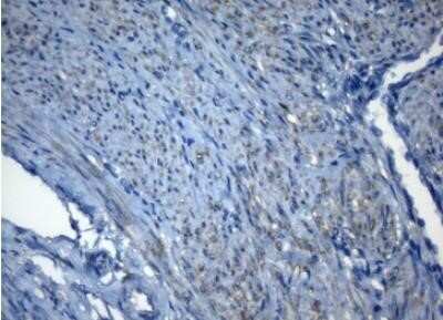 Immunohistochemistry: ZNF217 Antibody (OTI3G5) - Azide and BSA Free [NBP2-74933] - Staining of paraffin-embedded Human endometrium tissue within the normal limits using anti-ZNF217 mouse monoclonal antibody. (Heat induced epitope retrieval by 1mM EDTA in 10mM Tris buffer (pH8.5) at 120 degrees C for 3 min,(1:150)