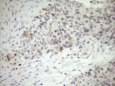 Immunohistochemistry: ZNF230 Antibody (OTI1E2) - Azide and BSA Free [NBP2-74934] - Analysis of Adenocarcinoma of Human endometrium tissue. (Heat-induced epitope retrieval by 1mM EDTA in 10mM Tris buffer (pH8.5) at 120C for 3 min)