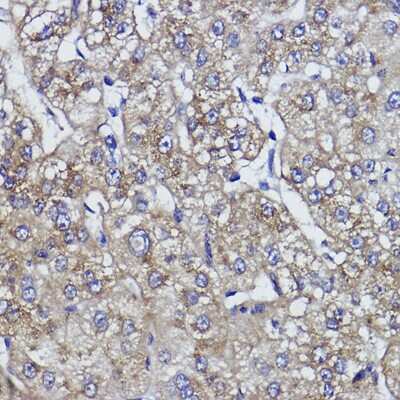 Immunohistochemistry-Paraffin: ZNF259 Antibody (10V1A2) [NBP3-15481] - Immunohistochemistry of paraffin-embedded human liver cancer using ZNF259 Rabbit mAb (NBP3-15481) at dilution of 1:100 (40x lens).Perform high pressure antigen retrieval with 10 mM citrate buffer pH 6.0 before commencing with IHC staining protocol.