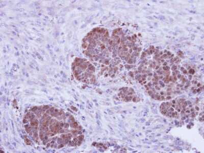 Immunohistochemistry-Paraffin: ZNF259 Antibody [NBP1-32965] - Paraffin-embedded NCIN87 xenograft, using antibody at 1:500 dilution.