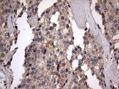 Immunohistochemistry: ZNF286 Antibody (OTI7D2) - Azide and BSA Free [NBP2-74935] - Analysis of Adenocarcinoma of Human breast tissue.