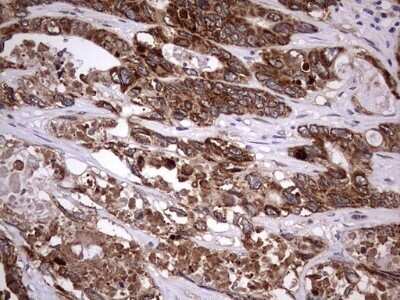 Immunohistochemistry: ZNF286 Antibody (OTI7D2) - Azide and BSA Free [NBP2-74935] - Analysis of Adenocarcinoma of Human colon tissue.