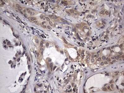 Immunohistochemistry: ZNF286 Antibody (OTI7D2) - Azide and BSA Free [NBP2-74935] - Analysis of Carcinoma of Human lung tissue.
