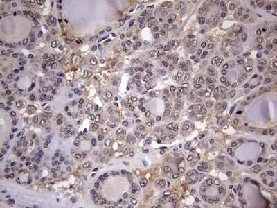 Immunohistochemistry: ZNF286 Antibody (OTI7D2) - Azide and BSA Free [NBP2-74935] - Analysis of Carcinoma of Human thyroid tissue.