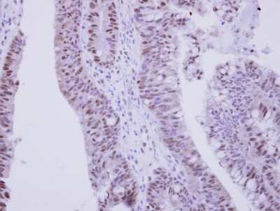 Immunohistochemistry-Paraffin: ZNF329 Antibody [NBP2-20993] - Immunohistochemical analysis of paraffin-embedded Colon ca, using antibody at 1:250 dilution.