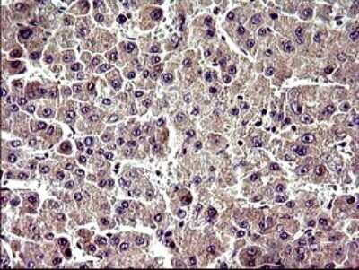 Immunohistochemistry: ZNF365 Antibody (9H5) [NBP2-46444] - Analysis of Carcinoma of Human liver tissue.(Heat-induced epitope retrieval by 10mM citric buffer, pH6.0, 120C for 3min)