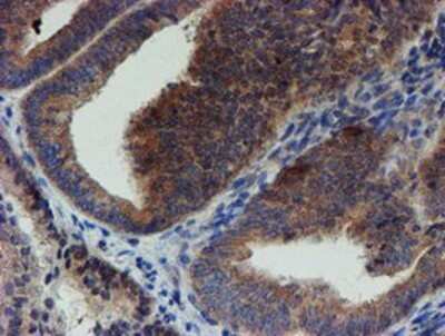 Immunohistochemistry: ZNF365 Antibody (OTI1B7) - Azide and BSA Free [NBP2-74945] - Staining of paraffin-embedded Adenocarcinoma of Human endometrium tissue using anti-ZNF365 mouse monoclonal antibody.