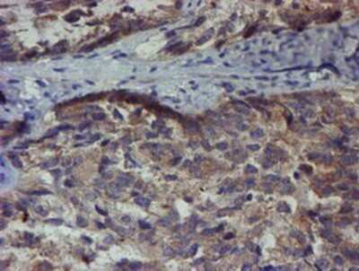 Immunohistochemistry: ZNF365 Antibody (OTI1B7) - Azide and BSA Free [NBP2-74945] - Staining of paraffin-embedded Adenocarcinoma of Human ovary tissue using anti-ZNF365 mouse monoclonal antibody.