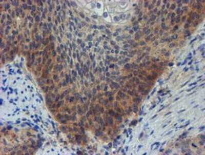 Immunohistochemistry: ZNF365 Antibody (OTI1B7) - Azide and BSA Free [NBP2-74945] - Staining of paraffin-embedded Carcinoma of Human bladder tissue using anti-ZNF365 mouse monoclonal antibody.