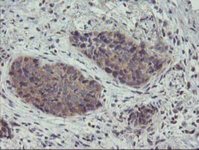 Immunohistochemistry: ZNF365 Antibody (OTI1B7) - Azide and BSA Free [NBP2-74945] - Staining of paraffin-embedded Carcinoma of Human lung tissue using anti-ZNF365 mouse monoclonal antibody.