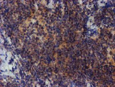 Immunohistochemistry: ZNF365 Antibody (OTI1B7) - Azide and BSA Free [NBP2-74945] - Staining of paraffin-embedded Human lymphoma tissue using anti-ZNF365 mouse monoclonal antibody.