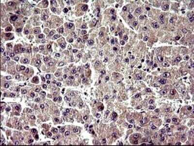 Immunohistochemistry: ZNF365 Antibody (OTI9H5) - Azide and BSA Free [NBP2-74939] - Analysis of Carcinoma of Human liver tissue.(Heat-induced epitope retrieval by 10mM citric buffer, pH6.0, 120C for 3min)