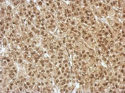 Immunohistochemistry-Paraffin: ZNF406 Antibody [NBP2-21005] - Immunohistochemical analysis of paraffin-embedded HBL435 xenograft, using antibody at 1:500 dilution.