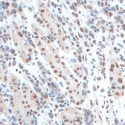 Immunohistochemistry-Paraffin: ZNF433 Antibody [NBP3-05110] - Immunohistochemistry of paraffin-embedded human gastric cancer using ZNF433 antibody (NBP3-05110) at dilution of 1:100 (40x lens). Perform microwave antigen retrieval with 10 mM PBS buffer pH 7.2 before commencing with IHC staining protocol.