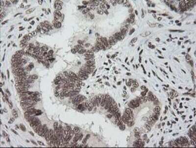 Immunohistochemistry: ZNF447 Antibody (OTI2H7) - Azide and BSA Free [NBP2-74951] - Analysis of Adenocarcinoma of Human colon tissue. (Heat-induced epitope retrieval by 10mM citric buffer, pH6.0, 120C for 3min)