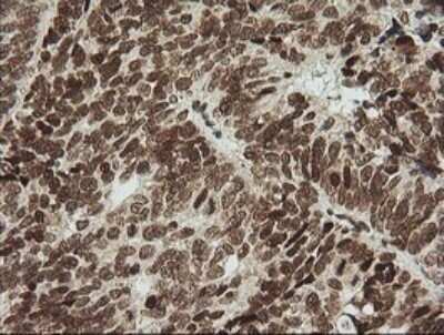 Immunohistochemistry: ZNF447 Antibody (OTI2H7) - Azide and BSA Free [NBP2-74951] - Analysis of Adenocarcinoma of Human ovary tissue. (Heat-induced epitope retrieval by 10mM citric buffer, pH6.0, 120C for 3min)