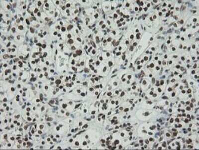Immunohistochemistry: ZNF447 Antibody (OTI2H7) - Azide and BSA Free [NBP2-74951] - Analysis of Carcinoma of Human kidney tissue.
