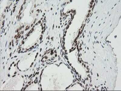 Immunohistochemistry: ZNF447 Antibody (OTI2H7) - Azide and BSA Free [NBP2-74951] - Analysis of Carcinoma of Human prostate tissue. (Heat-induced epitope retrieval by 10mM citric buffer, pH6.0, 120C for 3min)