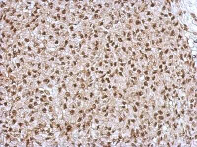 Immunohistochemistry-Paraffin: ZNF567 Antibody [NBP2-21028] - HBL435 xenograft, using ZNF567 antibody at 1:500 dilution. Antigen Retrieval: Trilogy™ (EDTA based, pH 8.0) buffer, 15min. 