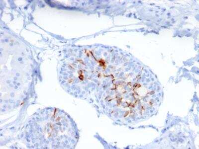 Immunohistochemistry-Paraffin: ZNF690 Antibody (ZSCAN29/2610) - Azide and BSA Free [NBP2-79881] - Formalin-fixed, paraffin-embedded human Breast Carcinoma stained with ZNF690 / ZSCAN29 Mouse Monoclonal Antibody (ZSCAN29/2610).