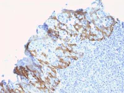 Immunohistochemistry-Paraffin: ZNF690 Antibody (ZSCAN29/2610) - Azide and BSA Free [NBP2-79881] - Formalin-fixed, paraffin-embedded human Breast Carcinoma stained with ZNF690 / ZSCAN29 Mouse Monoclonal Antibody (ZSCAN29/2610).
