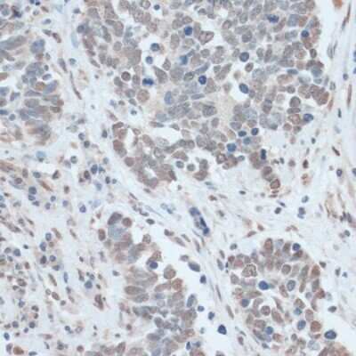 Immunohistochemistry-Paraffin: ZNF707 Antibody [NBP3-05075] - Paraffin-embedded human lung cancer using ZNF707 antibody at dilution of 1:100 (40x lens).