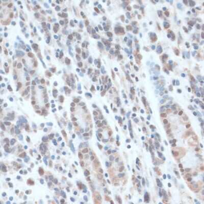 Immunohistochemistry-Paraffin: ZNF707 Antibody [NBP3-05075] - Paraffin-embedded human gastric cancer using ZNF707 antibody at dilution of 1:100 (40x lens).