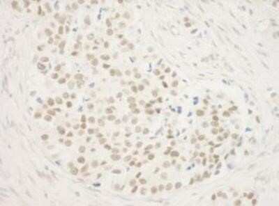 Immunohistochemistry: ZNF768 Antibody [NBP1-78220] - FFPE section of human breast carcinoma.  Antibody: Affinity purified rabbit anti-ZNF768 used at a dilution of 1:250.