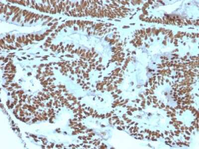Immunohistochemistry-Paraffin: ZNF846 Antibody (ZNF846/2687) [NBP3-07853] - Formalin-fixed, paraffin-embedded human Breast Carcinoma stained with ZNF846 Mouse Monoclonal Antibody (ZNF846/2687).