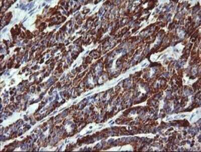 Immunohistochemistry: ZSCAN21/ZFP38 Antibody (OTI2E5) - Azide and BSA Free [NBP2-74956] - Analysis of Carcinoma of Human thyroid tissue. (Heat-induced epitope retrieval by 10mM citric buffer, pH6.0, 120C for 3min)