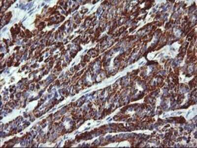 Immunohistochemistry: ZSCAN21/ZFP38 Antibody (OTI2E5) [NBP2-45443] - Analysis of Carcinoma of Human thyroid tissue. (Heat-induced epitope retrieval by 10mM citric buffer, pH6.0, 120C for 3min)