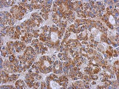 Immunohistochemistry-Paraffin: ZSWIM2 Antibody [NBP2-21056] - Immunohistochemical analysis of paraffin-embedded Hepatoma, using antibody at 1:500 dilution.