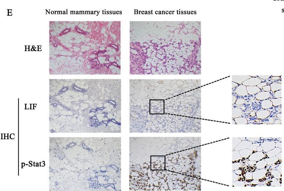 Knockdown of endogenous Stat3 with siRNA inhibits the migration and invasion of breast cancer cells induced by CAA-CM and rhLIF. (A-D) MDA-MB-231 cells transfected with siRNA were treated with rhLIF (A and B) or CAA-CM (C and D) to observe cell migration and invasion. (E) The expression of LIF and Stat3 phosphorylation in normal breast tissue and breast cancer tissue was analyzed by IHC, scale bar: 100 μm. (F) The correlation between the relative expression of LIF and Stat3 phosphorylation in human breast cancer sections. Typical microscopic fields and blots are shown and quantitative data are presented as mean ± SD from at least three independent experiments. #p < 0.05, ##p < 0.01, ###p < 0.001, NS + rhLIF or CAA-CM VS. NS; *p < 0.05, **p < 0.01, ***p < 0.001, siRNA+rhLIF or CAA-CM VS. NS + rhLIF or CAA-CM. Image collected and cropped by CiteAb from the following open publication (//pubmed.ncbi.nlm.nih.gov/35280694), licensed under a CC-BY license. Not internally tested by R&D Systems.