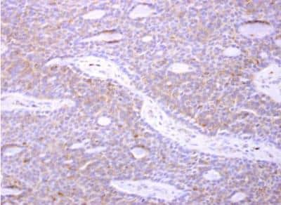 Immunohistochemistry-Paraffin: actin-related protein 2/3 complex subunit 1B Antibody [NBP2-15263] - Paraffin-embedded human lung carcinoma. p41-ARCb antibody [N1], N-term dilution: 1:500