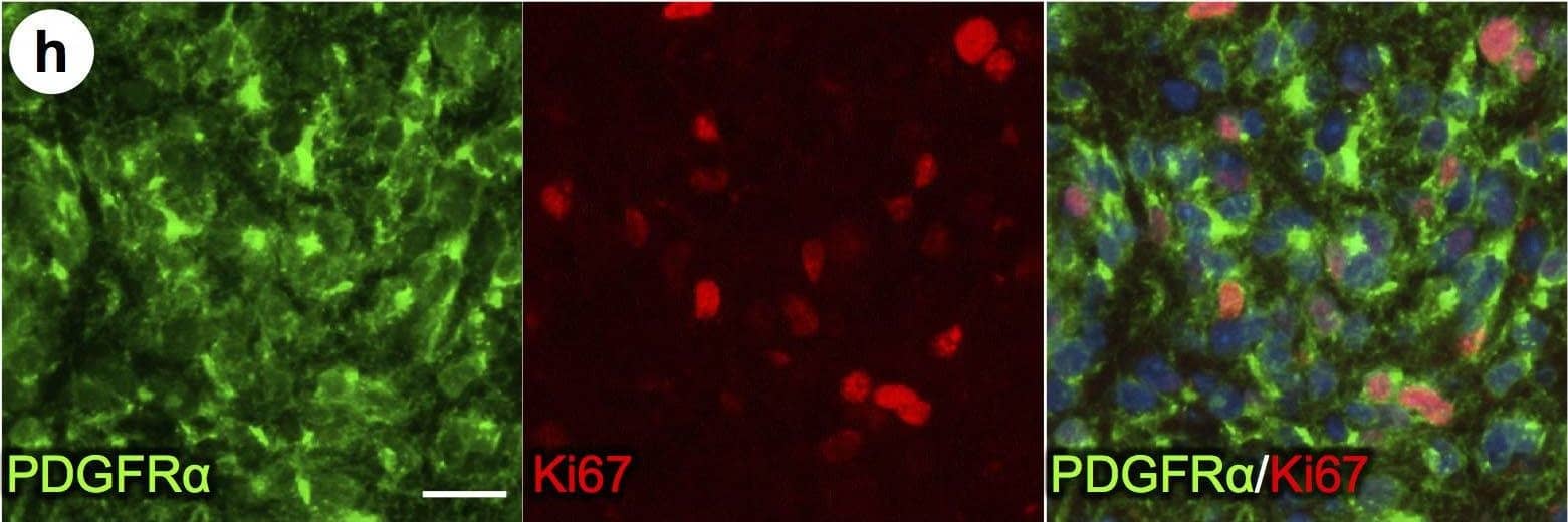 PDGFR alpha  driven brain tumors display features of high grade glioma.(a–g) Histopathological analysis of tumor areas by H&E staining shows a high concentration of mitotic figures (a, arrows), high cellularity and nuclear atypia (b), perineuronal satellitosis (c; N, neuronal nuclei), perivascular growth (d), intrafascicular growth (e), subarachnoid spreading (f), and areas of incipient necrosis (g; arrows point to pyknotic nuclei). (h–k) IF labeling of brain tumor sections for cell type specific markers. Nuclei labeled with DAPI are shown in blue. Tumor cells with high PDGFR alpha  expression were highly proliferative, as seen by proliferation marker Ki67 (h), and express the OPC cell lineage markers Olig2, Sox2, Sox10, and Ng2, as well as the neural stem cell marker Nestin (i–k). Tumor cells were negative for immunosignal of astroglial marker GFAP, mature oligodendrocyte marker APC-CC1, and neuronal marker NeuN (l–n). Scale bars: 10 μm (a–g), 20 μm (h–n). Image collected and cropped by CiteAb from the following publication (//pubmed.ncbi.nlm.nih.gov/25683249), licensed under a CC-BY license. Not internally tested by R&D Systems.