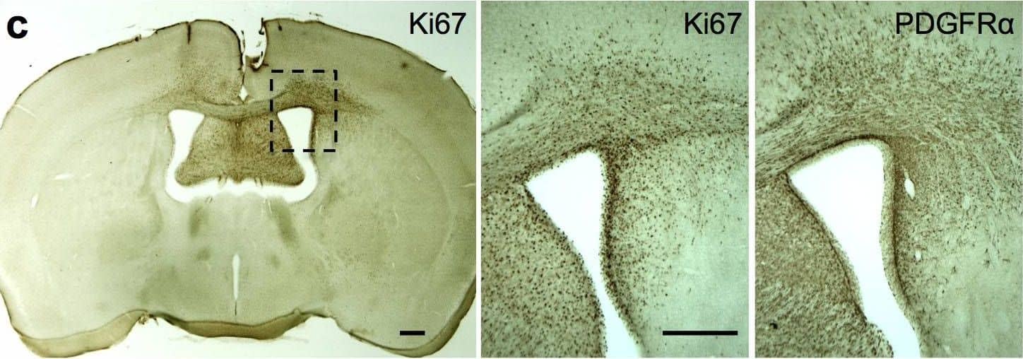 <b>Genetic Strategies Validation. </b>PDGFR alpha  driven brain tumor model.(a) Schematic diagram of PDGFR alpha  J/K knock-in alleles. ATG, start codon; SA, splice acceptor; STOP, PGK-neo cassette. (b) Kaplan-Meier survival curves of 4 mouse mutant cohorts with brain tumors. Mice generally succumbed to subcutaneous fibrosarcomas, and brain tumors were detected by histological analysis. (c) Example of early stage tumor growth, as revealed by IHC for proliferation marker Ki67 and PDGFR alpha . Note high density of Ki67+ proliferating cells in tumor area, increased expression level of PDGFR alpha , and invasive migration of tumor cells through corpus callosum into contralateral hemisphere. (d) H&E staining of an advanced brain tumor growth (asterisk in tumor centre, dashed line demarcates expansion). Scale bars: 50 μm (c, d). Image collected and cropped by CiteAb from the following publication (//pubmed.ncbi.nlm.nih.gov/25683249), licensed under a CC-BY license. Not internally tested by R&D Systems.