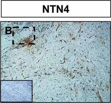 Immunohistochemistry of NTN4 expression within NB. Representative light microscopy images of a neuroblastoma sample from a female patient (age > 18M); tumor with retroperotineal location and in disseminated stage. (a) Hematoxylin and eosin staining reveals presence of ganglionar-differentiated cells (yellow arrowhead) and primitive neuroblasts (yellow asterisk). (b) Immunohistochemistry of NTN4 with its corresponding negative control (inset). (c) PCNA staining. (d) NTN4 is expressed preferentially in the endothelium (yellow arrows), as confirmed by CD31 staining (inset). (e) Detail of ganglionar-differentiated cells with strong NTN4 cytoplasmic expression in a characteristic punctuated pattern (yellow arrowhead). (f) Close up image of (b) as indicated, highlighting NTN4 expression within the stroma (yellow asterisk). A, B, C; Scale bar = 40 μm. D, E, F; Scale bar = 10 μm; inset = 10 μm. Image collected and cropped by CiteAb from the following open publication (//pubmed.ncbi.nlm.nih.gov/30160193), licensed under a CC-BY license. Not internally tested by R&D Systems.